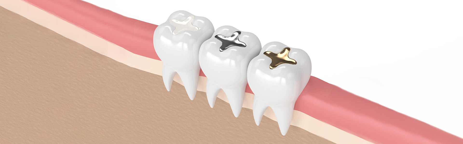 5 Signs You May Require a Dental Filling from Your Chelmsford Dentist