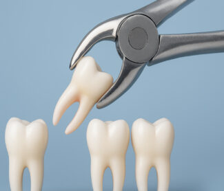 Exploring the Causes and Risks of Impacted Wisdom Teeth